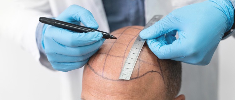 Hair Transplant London Cost – What You Need to Know