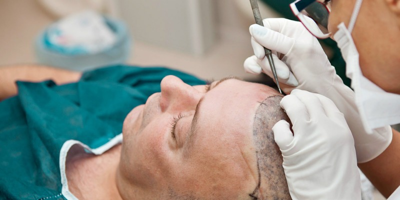 Hair Transplant Istanbul: Modern Solutions for Hair Loss